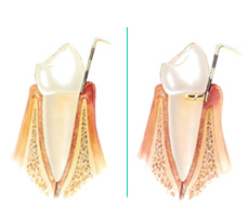 gingivitis1