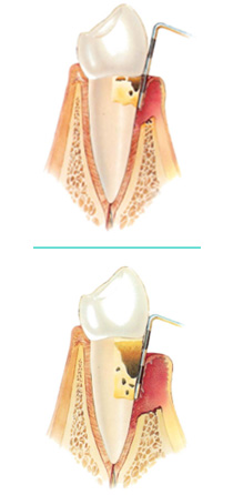 gingivitis2