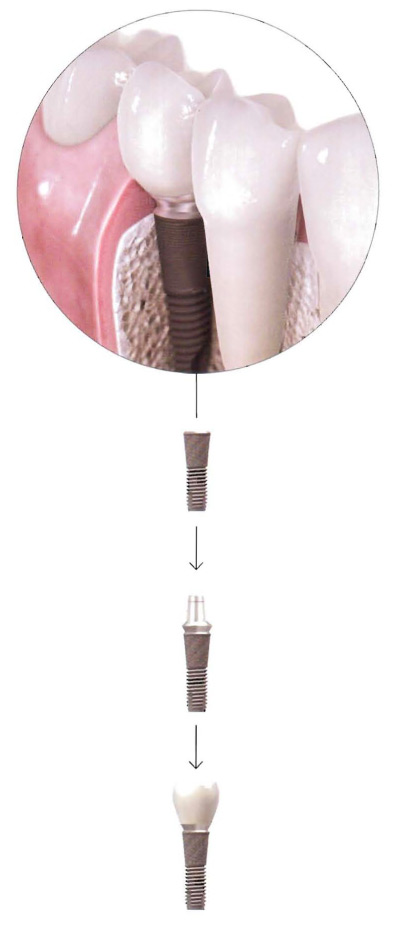 Implantes