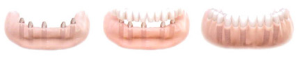 Sustitución de todos los dientes