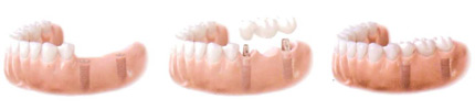 Sustitución de varios dientes
